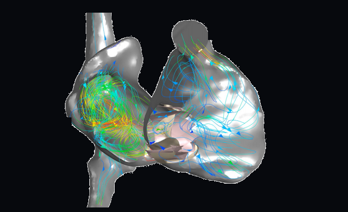 Patient-specific right-heart simulation showing intracardiac flow streamlines and an implanted valve.